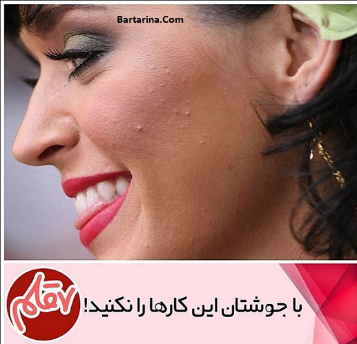 درمان سریع جوش صورت برای دید و بازدید عید نوروز 96