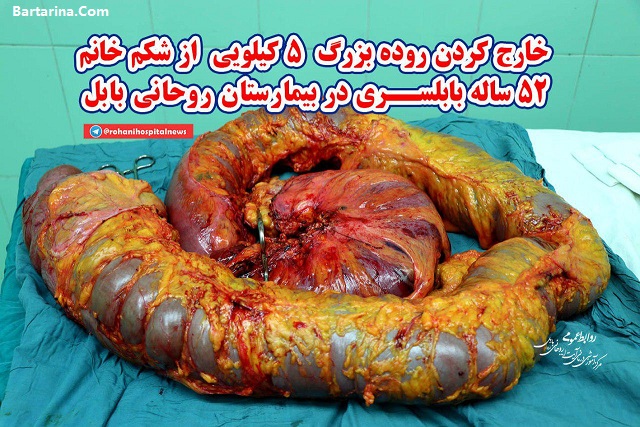 فیلم خارج کردن روده 5 کیلویی از شکم خانم 52 ساله بابلسری