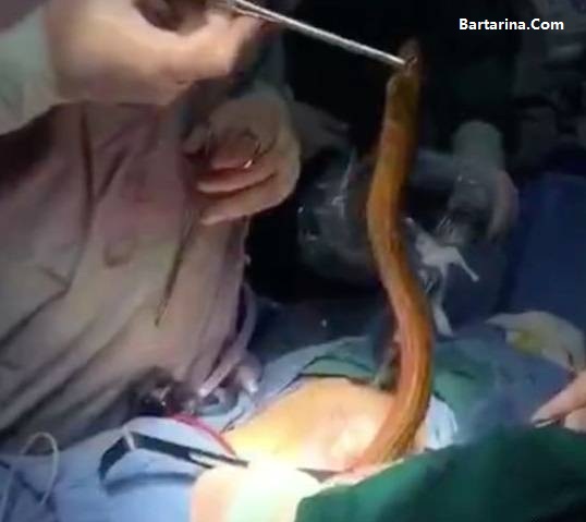 فیلم خارج کردن مار ماهی زنده از شکم مرد چینی + دلیل