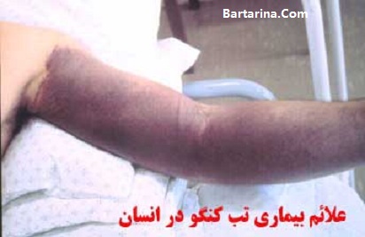 تب کریمه کنگو در اصفهان 5 خرداد 96 + تب کریمه کنگو در ایران