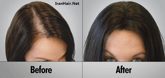 کاشت مو از سیر تا پیاز و هر آنچه که باید بدانید