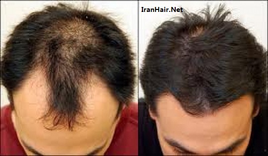 کاشت مو از سیر تا پیاز و هر آنچه که باید بدانید
